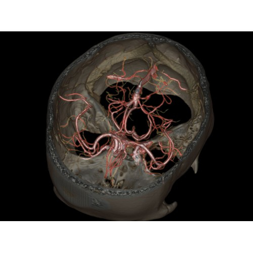 КТ аппарат GE Brivo CT385